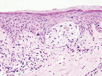 Imagen: Histopatología del melanoma (Fotografía cortesía de Priscilla Lynch).
